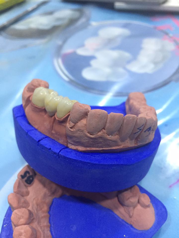 Gallery Crown Dental Lab